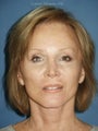 Facelift, Endoscopic Browlift, Upper and Lower Blepharoplasty, Perioral Dermabrasion