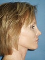 Facelift, Endoscopic Browlift, Upper and Lower Blepharoplasty, Perioral Dermabrasion