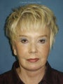 Facelift, Endoscopic Browlift, Upper and Lower Blepharoplasty with canthopexy, Perioral and Glabellar Dermabrasion