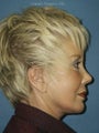 Facelift, Endoscopic Browlift, Upper and Lower Blepharoplasty with canthopexy, Perioral and Glabellar Dermabrasion
