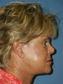 Facelift, Endoscopic Browlift, Upper and Lower Blepharoplasty, Lip Augmentation with Fat injections