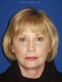 Facelift, Endoscopic Browlift, Upper and Lower Blepharoplasty, Perioral Dermabrasion