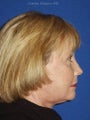 Facelift, Endoscopic Browlift, Upper and Lower Blepharoplasty, Perioral Dermabrasion