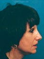 Facelift, Endoscopic Browlift, Bilateral Lower Blepharoplasty