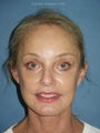 Facelift, Endoscopic Browlift, Upper and Lower Blepharoplasty with canthopexy, soft tissue fillers to the lips
