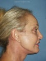 Facelift, Endoscopic Browlift, Upper and Lower Blepharoplasty with canthopexy, soft tissue fillers to the lips