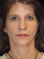 Face lift,brow lift, eyelid lift
