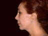 Face lift, brow lift, eyelid lift