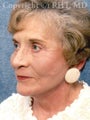 Forehead lift, SMAS facelift, platysmaplasty, upper and lower eyelid lifts