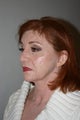 Facelift
