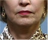 Lower facelift, necklift, CO2 laser resurfacing