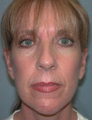 Facelift