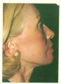 Facelift
