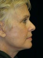 Lower Face lift