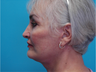 Facelift
