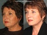 Facelift