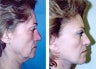 Facelift
