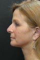 Facelift