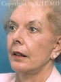 SMAS facelift/necklift; upper blepharoplasty' chin implant