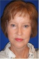 Facelift, Neck lift, Browlift, Lower Blepharoplasty (eyelid lift)