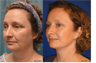 Facelift, Neck liposuction and lift, Endoscopic Browlift, Upper Blepharoplasty (eyelid lift)