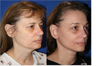 Facelift, Necklift, Browlift Lower Blepharoplasty (eyelid lift), Laser scar/facial resurfacing