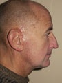 Facelift, Fat Injection, Neck Lift