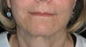 "Liquid facelift" with filler