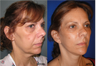 Facelift, Neck lift, Browlift, Upper and Lower Blepharoplasty (eyelid lift)
