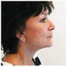 Upper and lower eyelids / face and neck lift and brow lift.
