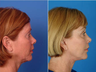 Facelift