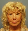 Facelift