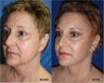 Facelift, necklift, lower blepharoplasty, browlift