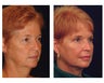 Full Facial Rejuvenation
