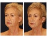 facelift, necklift