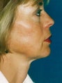 Facelift