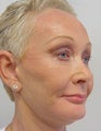 Facelift