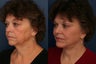 Composite facelift, midface lift, upper and lower blepharoplasty, browlift and chin implant
