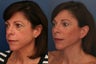 Composite facelift, midface lift, upper and lower blepharoplasty, browlift and cheek implants