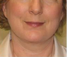 Facelift