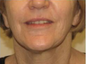 Facelift