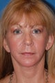 Facelift and Laser Resurfacing