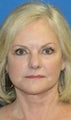 Short Incision Facelift and Lateral Browlift