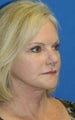 Short Incision Facelift and Lateral Browlift