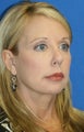 Facelift, Necklift, Fat Transfer, Upper Bleph., Lower Eyelid Skin Pinch