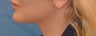 Facelift