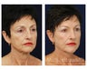 Facial Rejuvenation