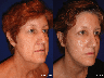 Facelift, necklift, upper & lower blepharoplasty, rhinoplasty