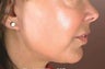 Facelift