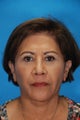 Face lift with upper and lower eyelid lift (blepharoplasty)